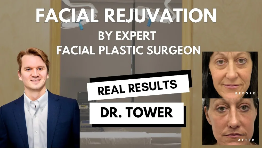 Before and after deep plane facelift — 52-year-old woman, frontal view, 6mo post-op by Dr. Jeffrey Spiegel