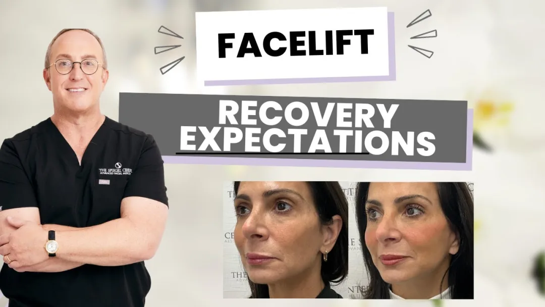 Before and after deep plane facelift — 48-year-old woman, oblique left view, 6mo post-op by Dr. Jeffrey Spiegel