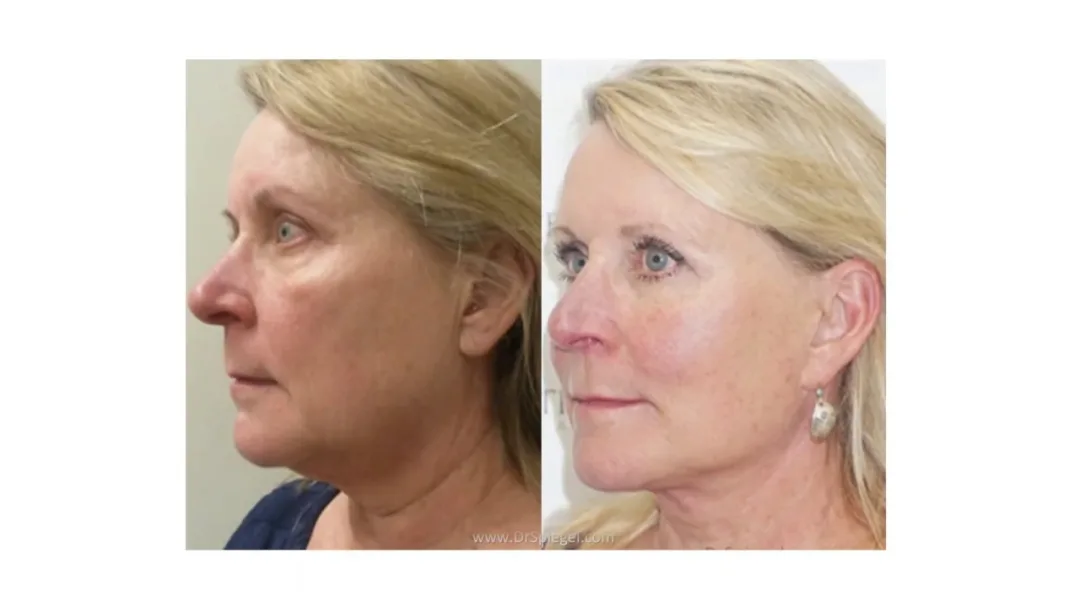 Before and after deep plane facelift — 55-year-old woman, left profile view, 6mo post-op by Dr. Jeffrey Spiegel