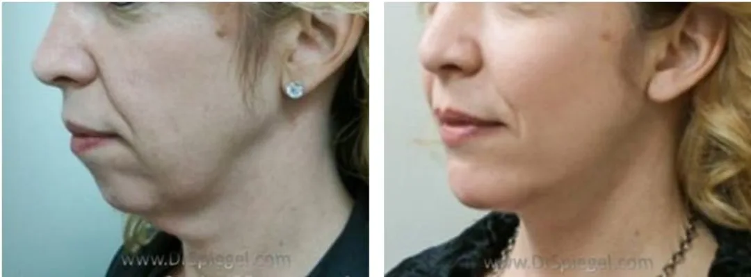 Before and after deep plane facelift — 55-year-old woman, left profile view, 6mo post-op by Dr. Jeffrey Spiegel