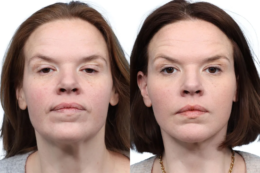 Before and after — Dr. Jeffrey Wise