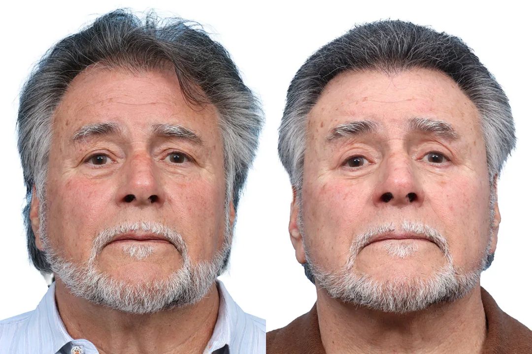 Before and after — Dr. Jeffrey Wise