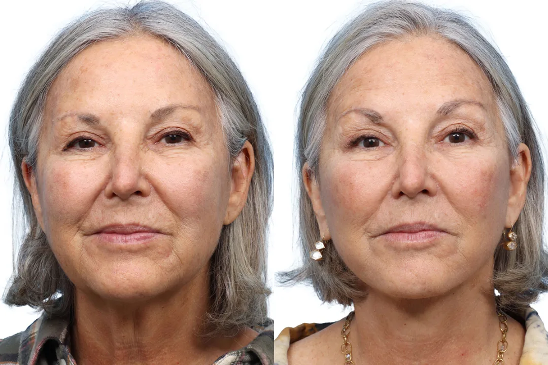 Before and after — Dr. Jeffrey Wise