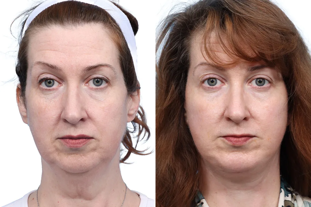 Before and after — Dr. Jeffrey Wise