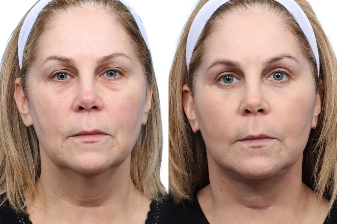 Before and after — Dr. Jeffrey Wise