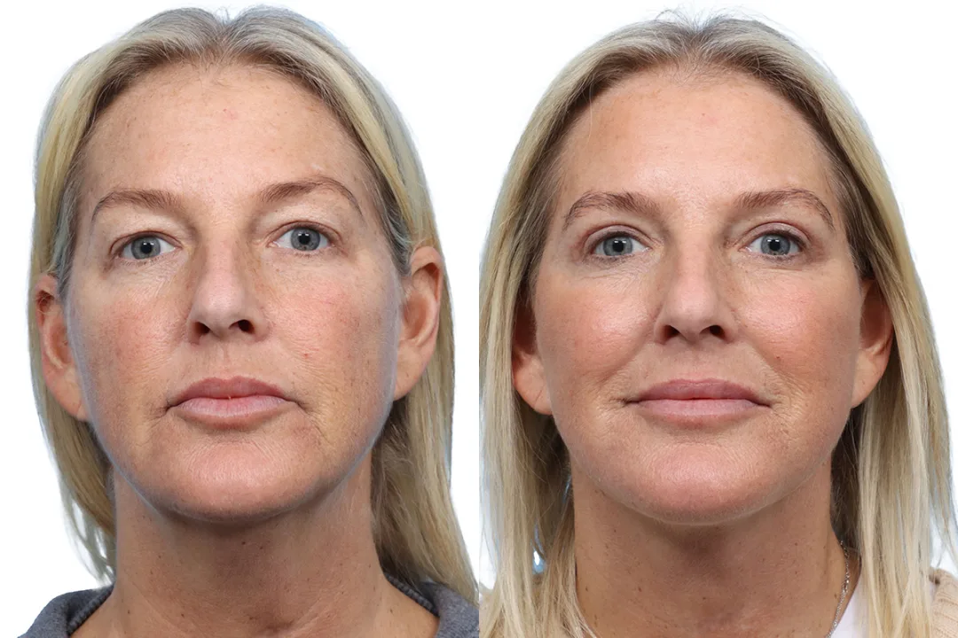 Before and after — Dr. Jeffrey Wise