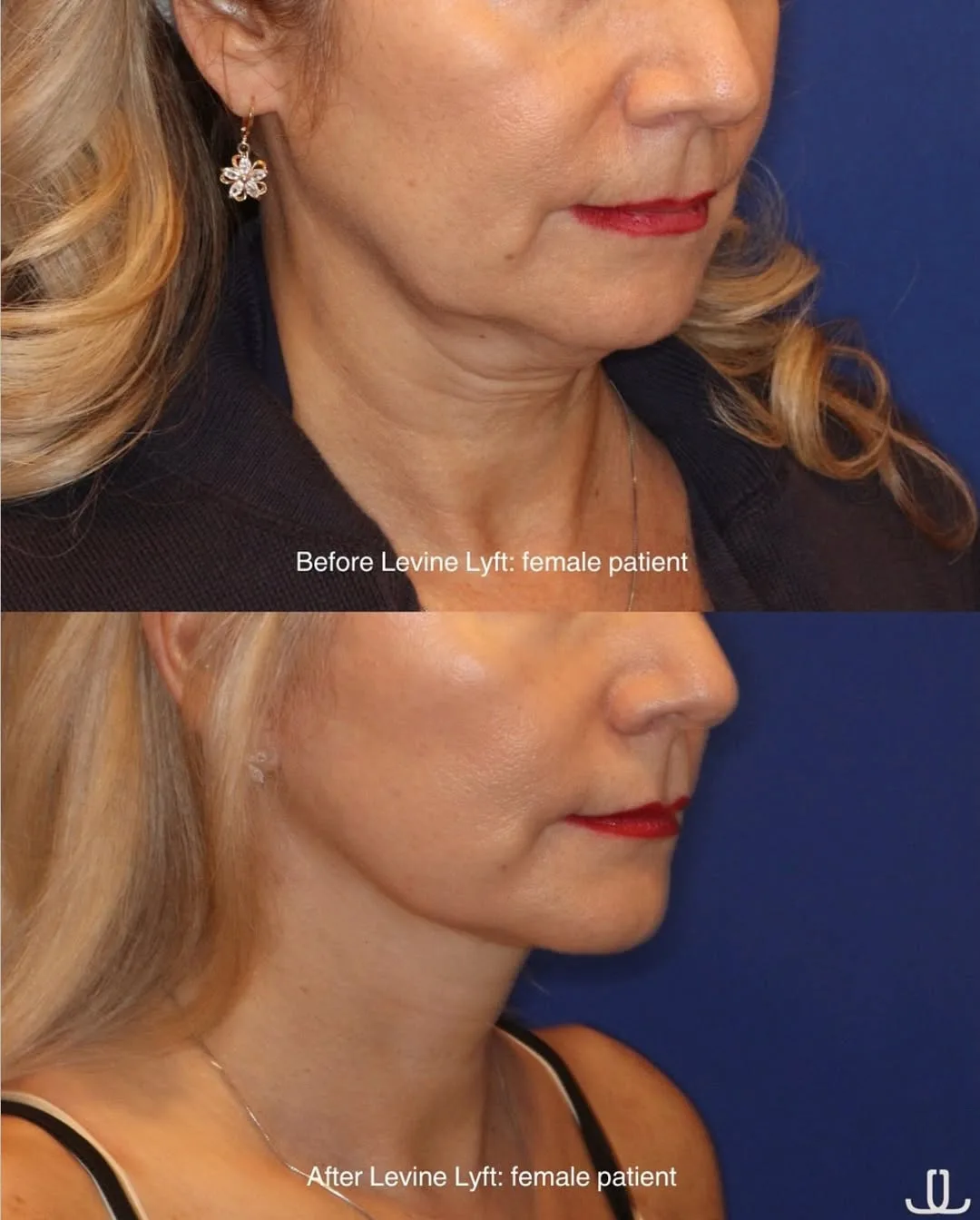 Before and after deep plane facelift — 55-year-old woman, three-quarter view, 7mo post-op by Dr. Jennifer Levine