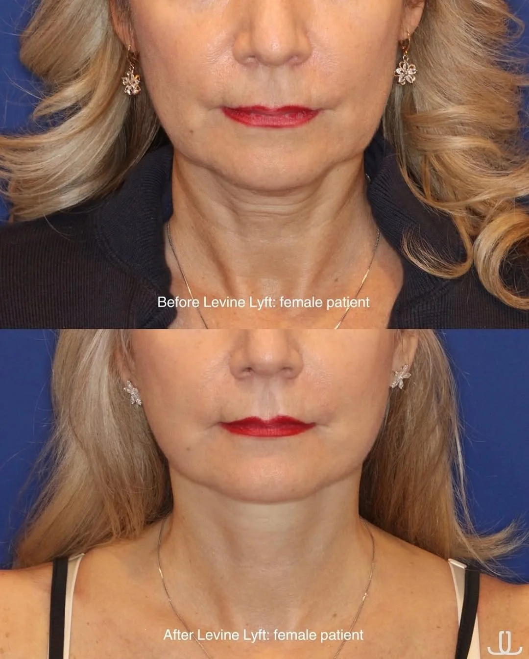 Before and after deep plane facelift — 55-year-old woman, frontal view, 7mo post-op by Dr. Jennifer Levine