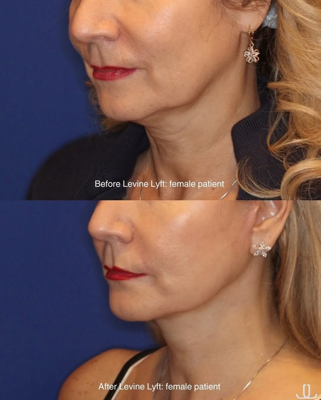 Before and after deep plane facelift — 52-year-old woman, three-quarter view, 7mo post-op by Dr. Jennifer Levine