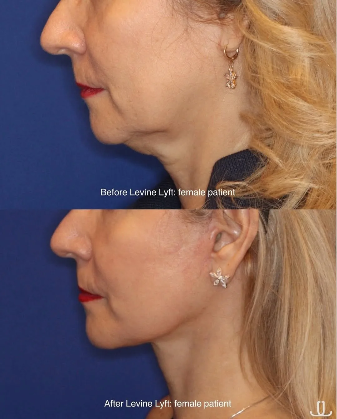 Before and after deep plane facelift — 55-year-old woman, three-quarter view, 7mo post-op by Dr. Jennifer Levine