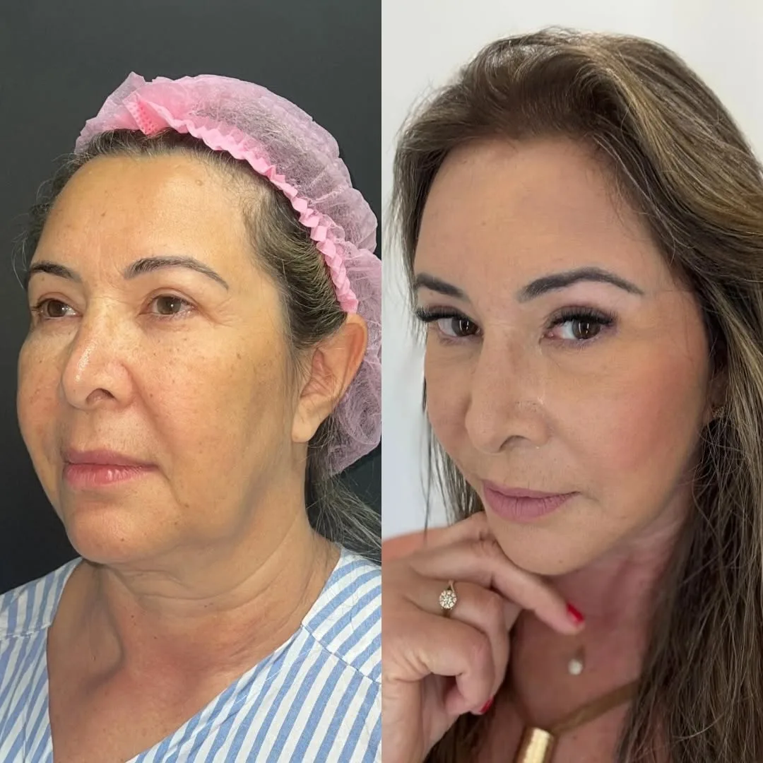 Before and after deep plane facelift — 55-year-old woman, oblique right view, 9mo post-op by Dr. Joao Zanirati