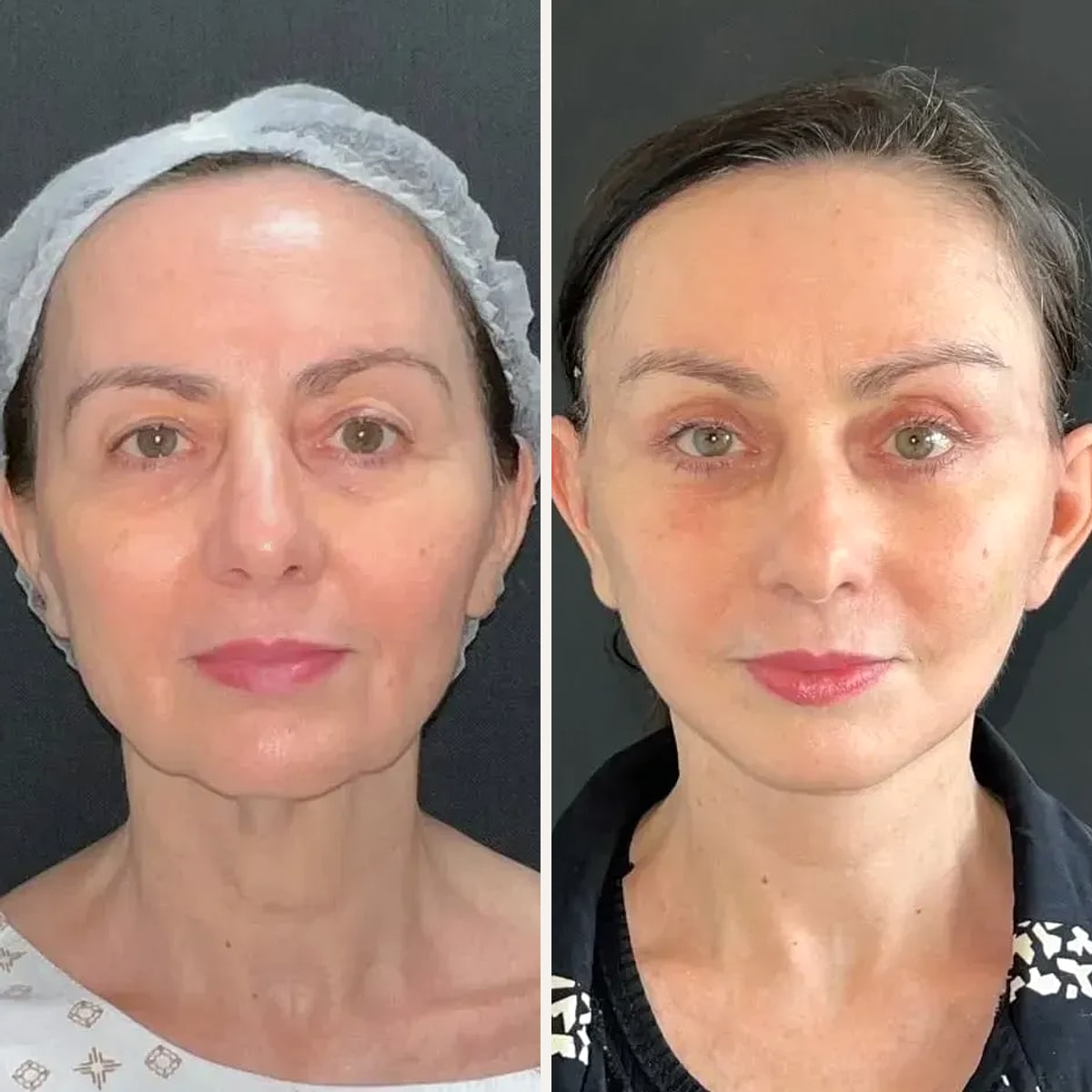 Before and after: Dr. Joao Zanirati