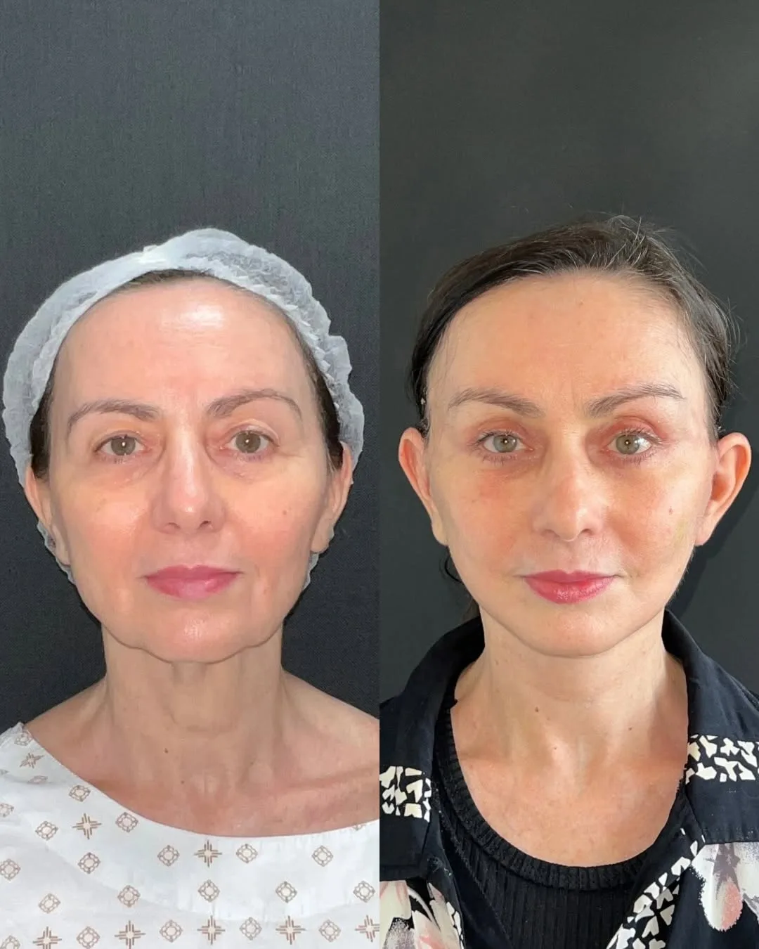 Before and after deep plane facelift — 48-year-old woman, frontal view, 4mo post-op by Dr. Joao Zanirati