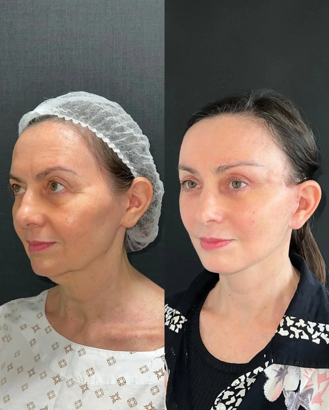 Before and after deep plane facelift — 48-year-old woman, oblique left view, 6mo post-op by Dr. Joao Zanirati