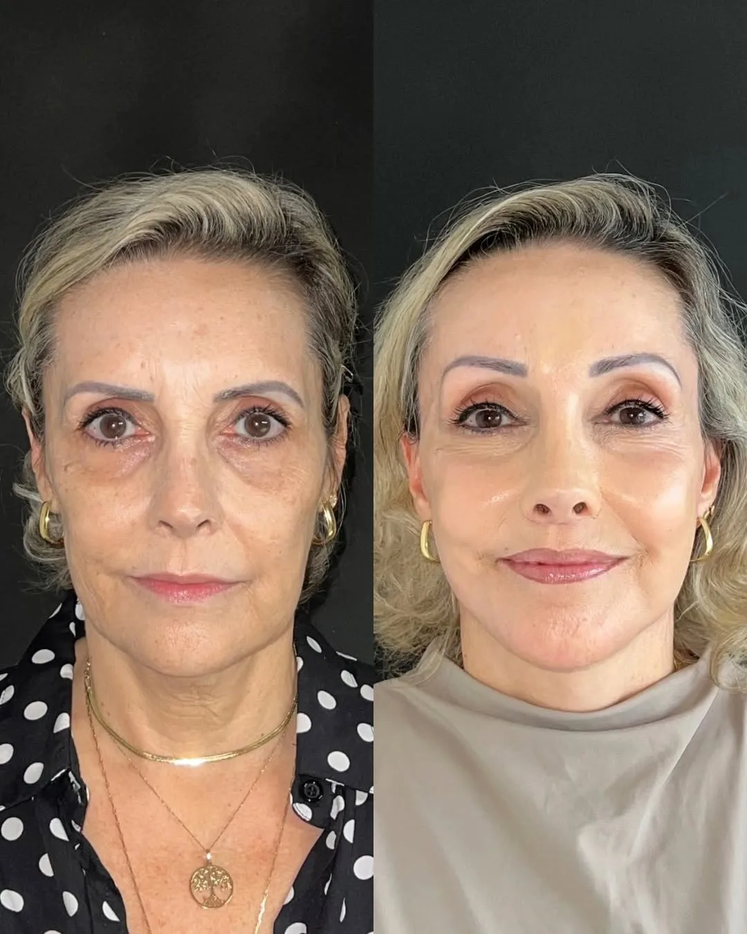 Before and after deep plane facelift — 55-year-old woman, frontal view, 7mo post-op by Dr. Joao Zanirati