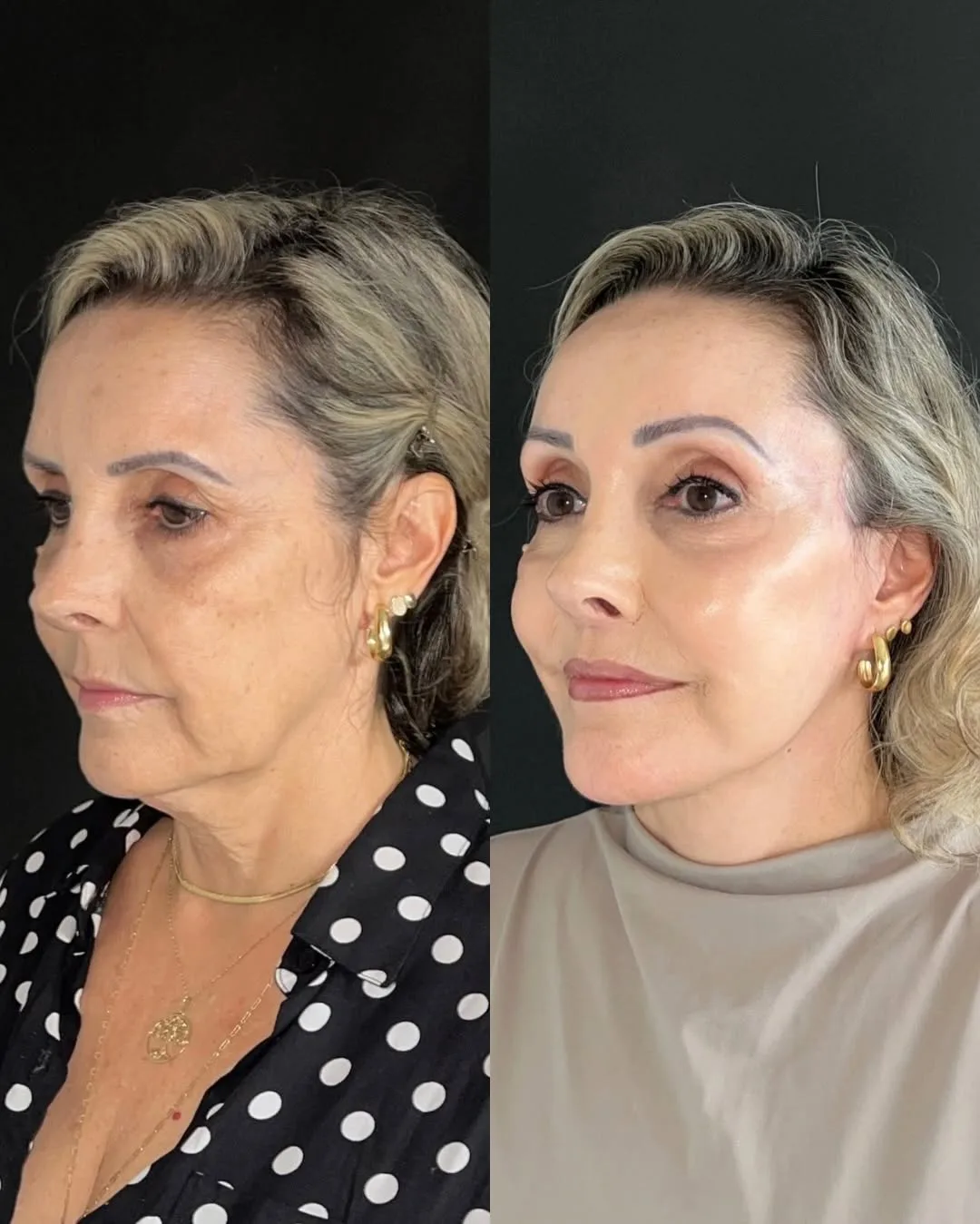 Before and after deep plane facelift — 55-year-old woman, oblique left view, 6mo post-op by Dr. Joao Zanirati