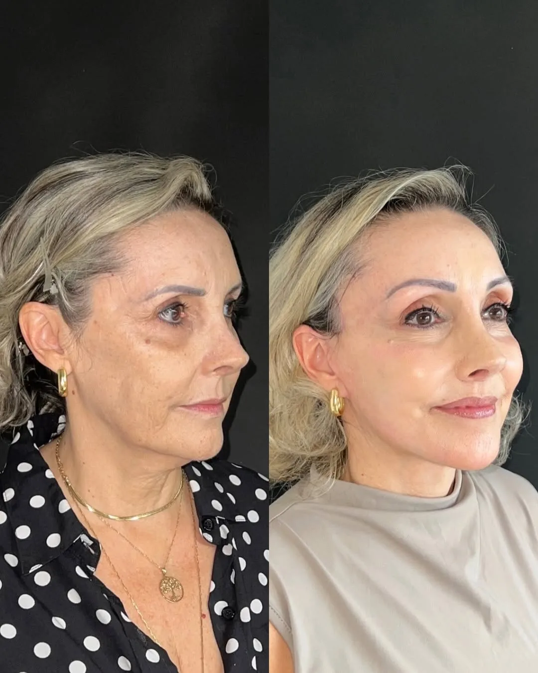 Before and after deep plane facelift — 55-year-old woman, oblique right view, 6mo post-op by Dr. Joao Zanirati