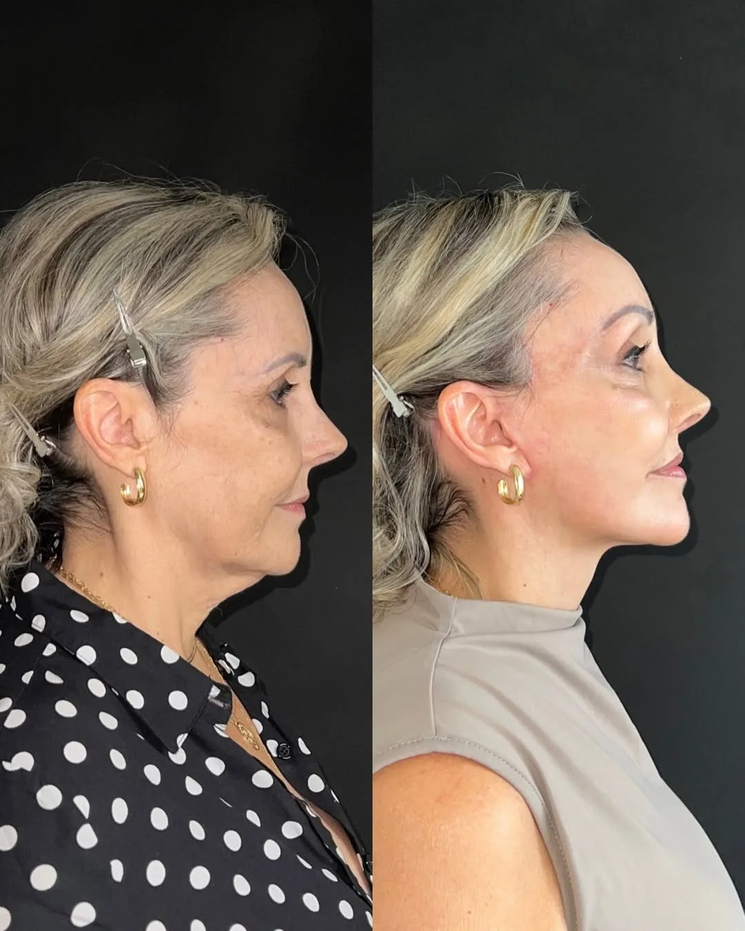 Before and after deep plane facelift — 52-year-old woman, left profile view, 7mo post-op by Dr. Joao Zanirati