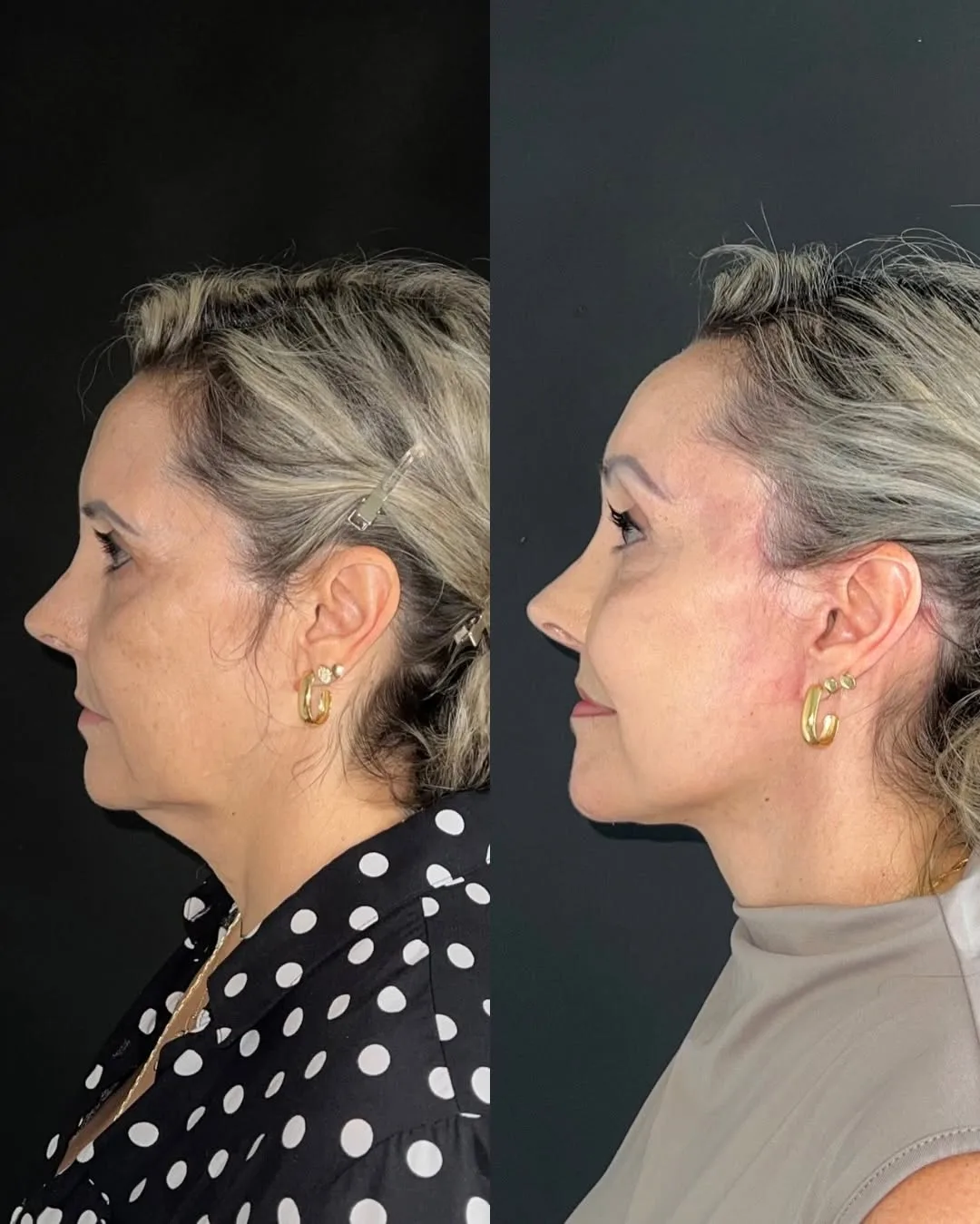 Before and after deep plane facelift — 52-year-old woman, right profile view, 6mo post-op by Dr. Joao Zanirati