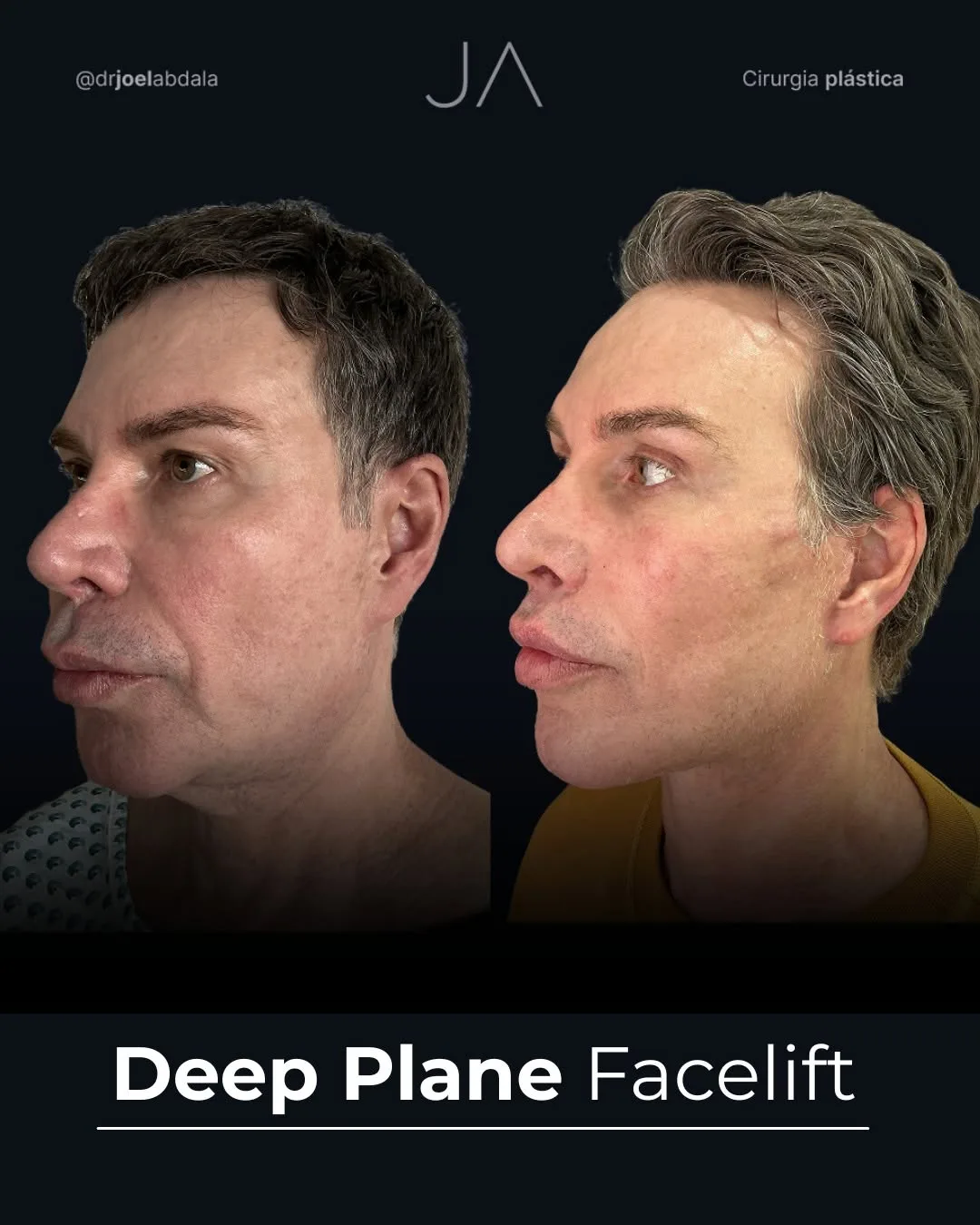 Before and after — Dr. Joel Abdala