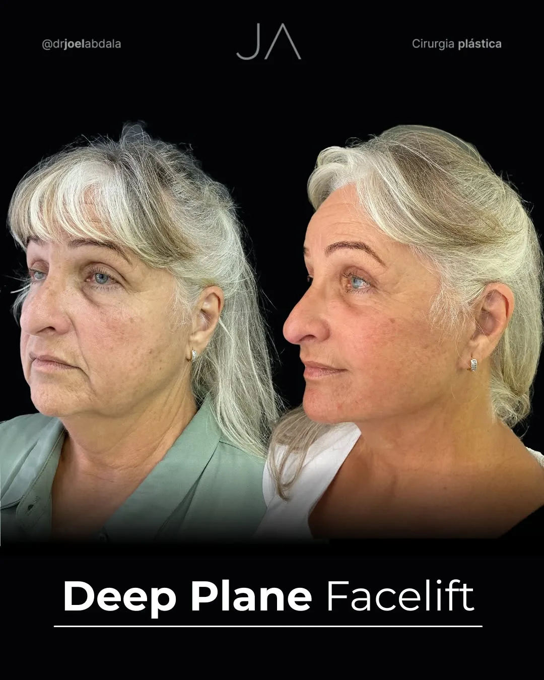 Before and after — Dr. Joel Abdala