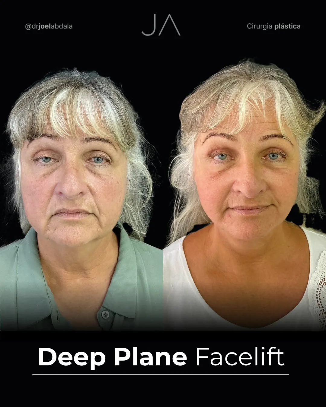 Before and after — Dr. Joel Abdala