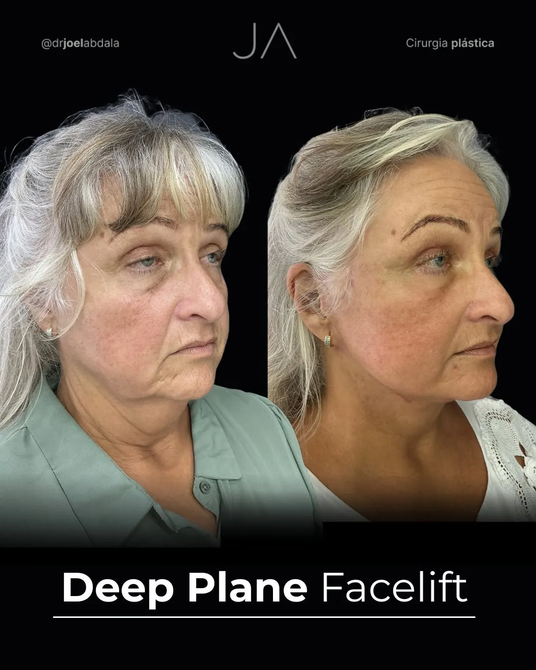 Before and after — Dr. Joel Abdala