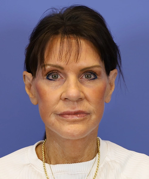 After deep plane facelift — 58-year-old woman, frontal view, 6mo post-op by Dr. John Bitner