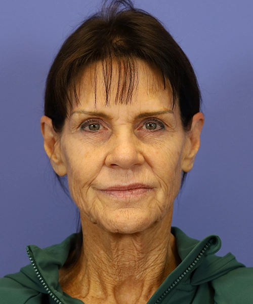 Before deep plane facelift — 58-year-old woman, frontal view, 6mo post-op by Dr. John Bitner