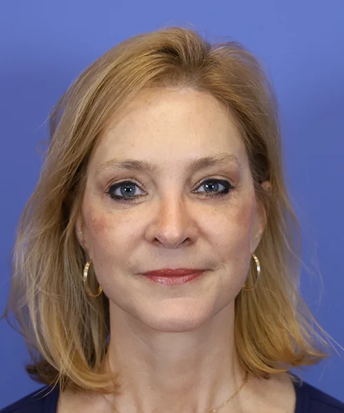 After deep plane facelift — 58-year-old woman, frontal view, 6mo post-op by Dr. John Bitner