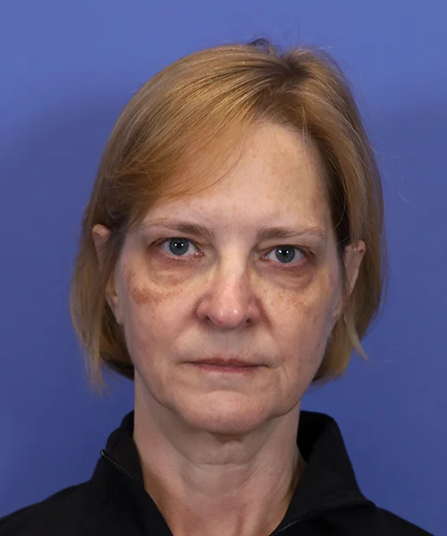 Before deep plane facelift — 58-year-old woman, frontal view, 6mo post-op by Dr. John Bitner