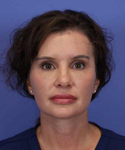 After deep plane facelift — 42-year-old woman, frontal view, 6mo post-op by Dr. John Bitner