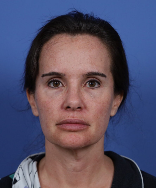 Before deep plane facelift — 42-year-old woman, frontal view, 6mo post-op by Dr. John Bitner