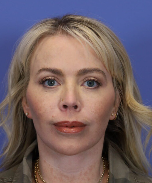 After deep plane facelift — 52-year-old woman, frontal view, 6mo post-op by Dr. John Bitner