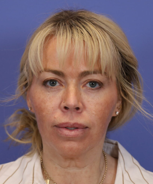 Before deep plane facelift — 52-year-old woman, frontal view, 6mo post-op by Dr. John Bitner