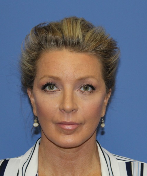 After deep plane facelift — 52-year-old woman, frontal view, 6mo post-op by Dr. John Bitner