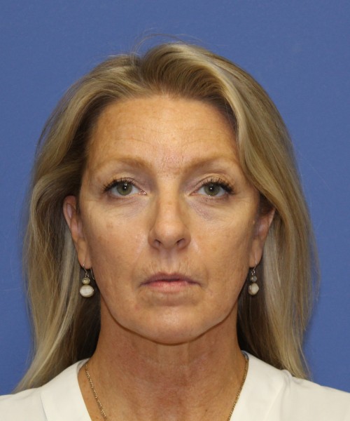 Before deep plane facelift — 52-year-old woman, frontal view, 6mo post-op by Dr. John Bitner