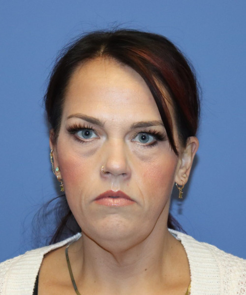 Before deep plane facelift — 45-year-old woman, frontal view, 3mo post-op by Dr. John Bitner