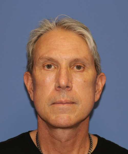 After deep plane facelift — 57-year-old man, frontal view, 6mo post-op by Dr. John Bitner