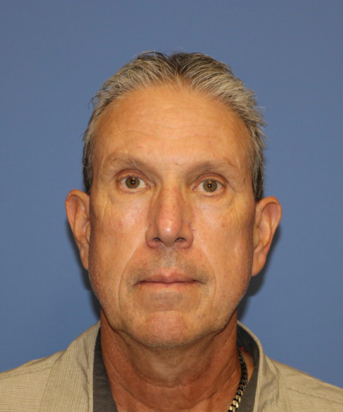 Before deep plane facelift — 57-year-old man, frontal view, 6mo post-op by Dr. John Bitner