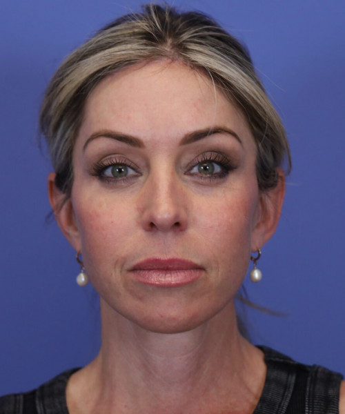 After deep plane facelift — 48-year-old woman, frontal view, 6mo post-op by Dr. John Bitner