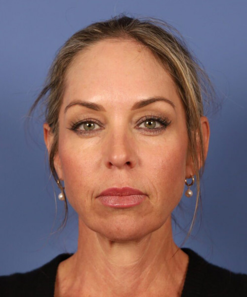 Before deep plane facelift — 48-year-old woman, frontal view, 6mo post-op by Dr. John Bitner