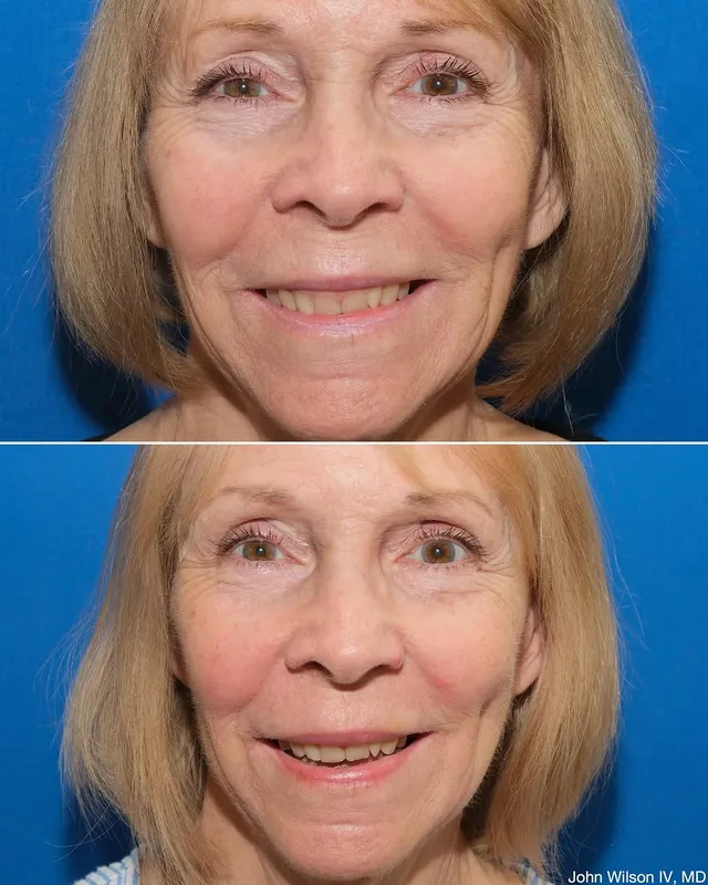 Before and after — Dr. John Wilson IV