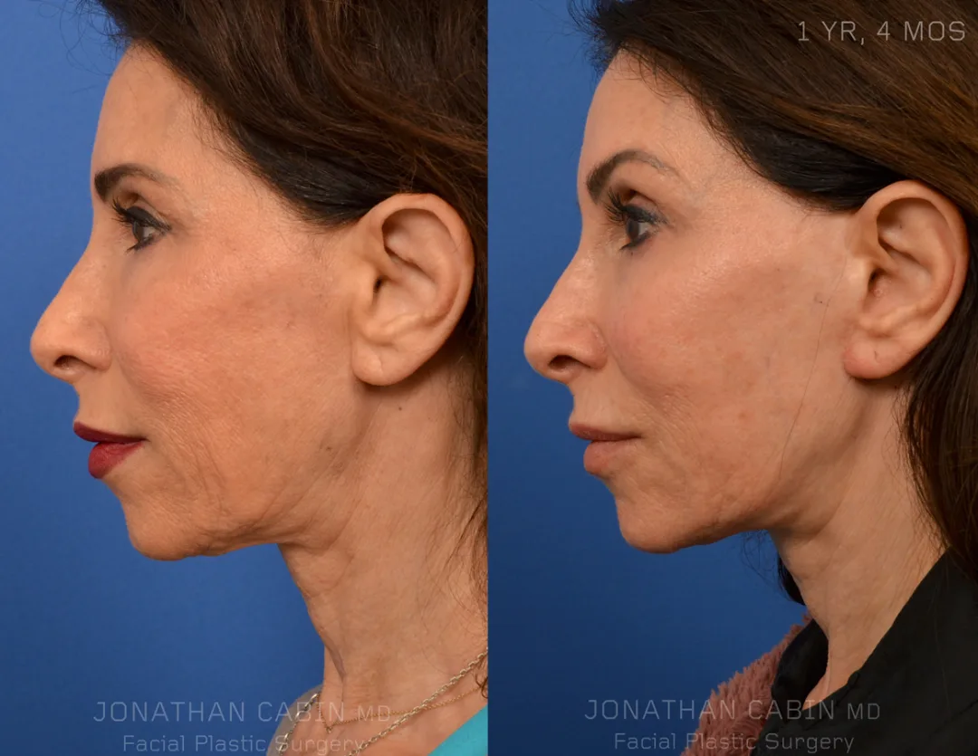 Before and after — Dr. Jonathan Cabin