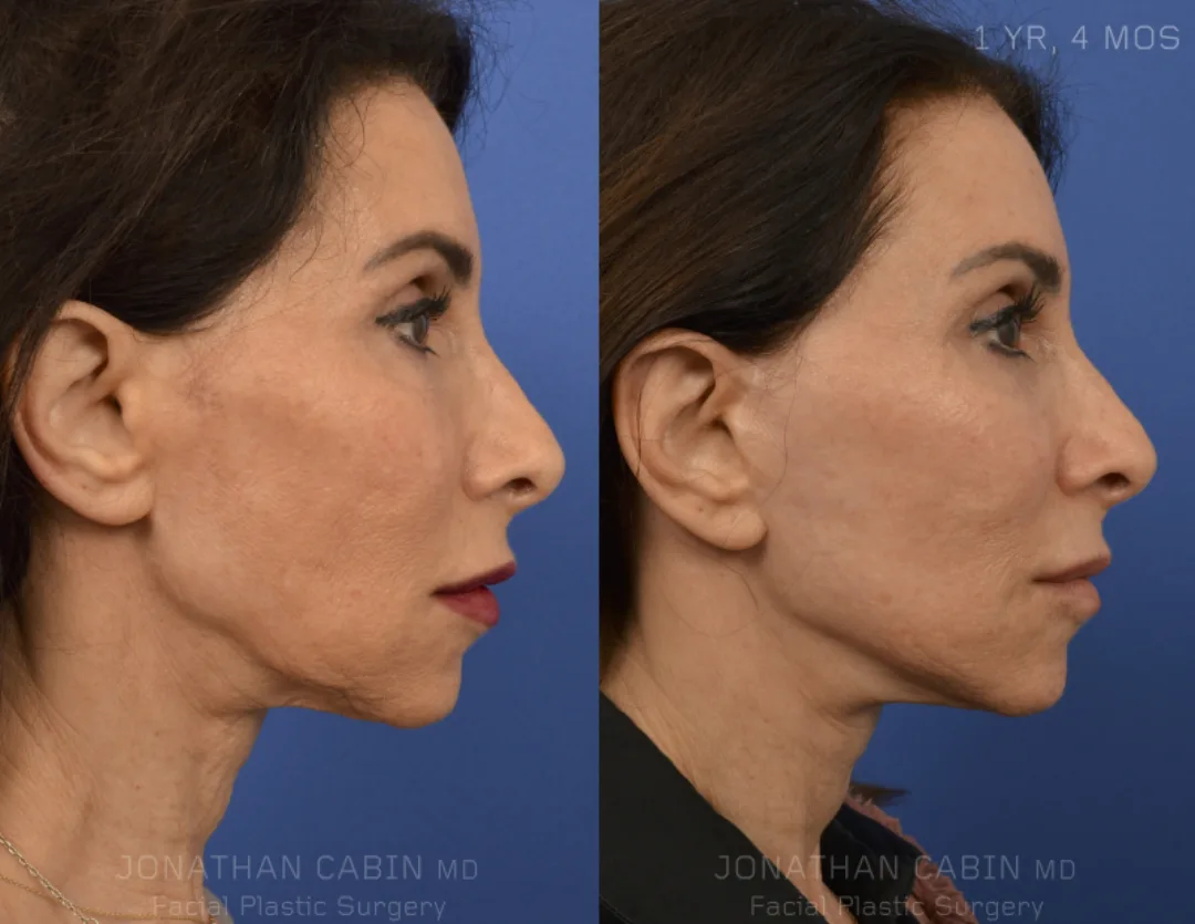 Before and after — Dr. Jonathan Cabin