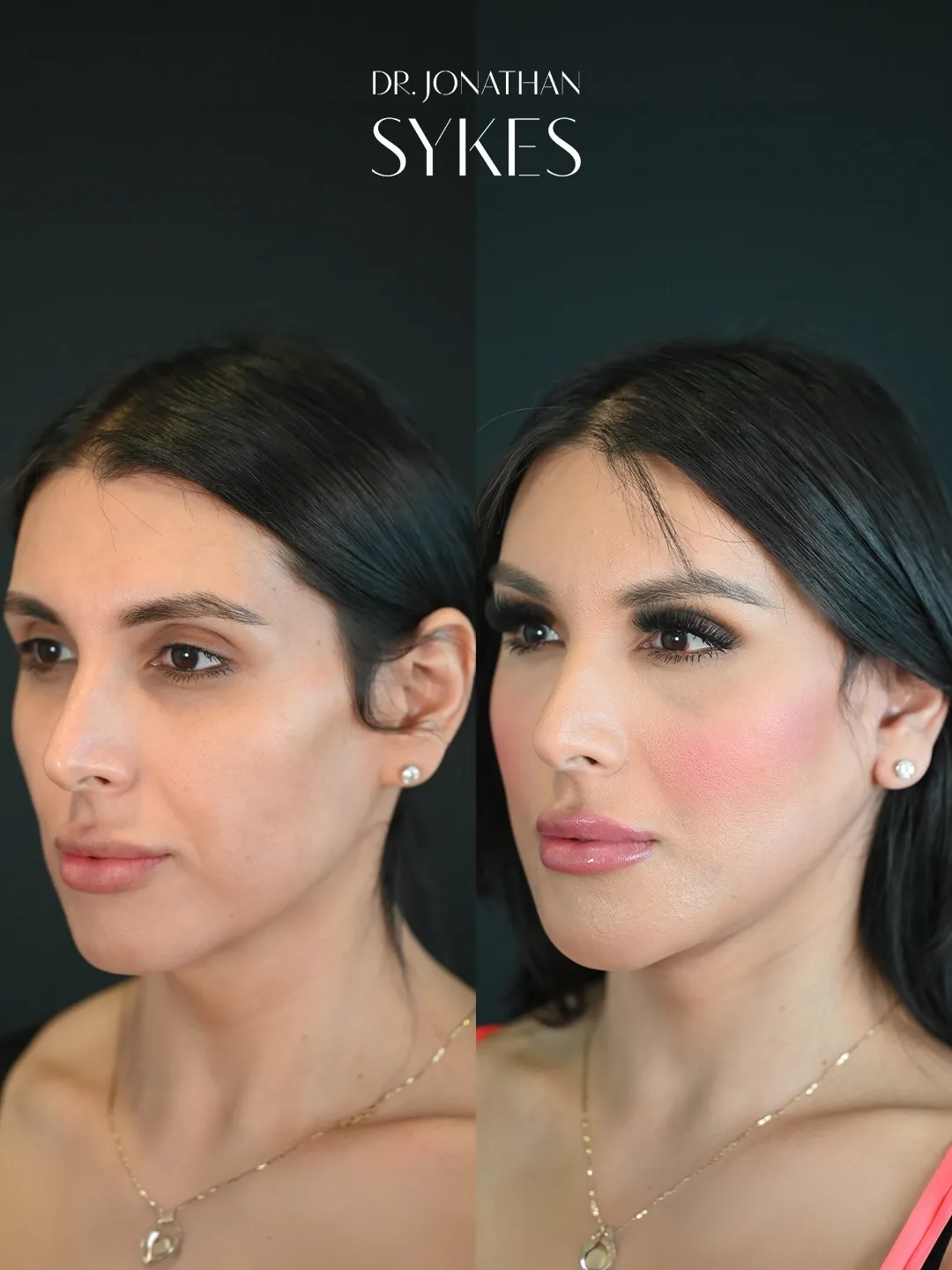 Before and after deep plane facelift — 32-year-old woman, oblique right view, 6mo post-op by Dr. Jonathan Sykes