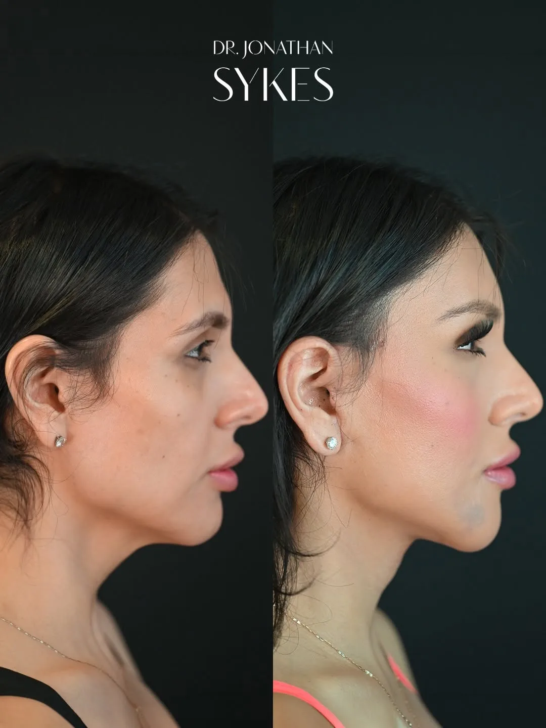 Before and after deep plane facelift — 28-year-old woman, right profile view, 6mo post-op by Dr. Jonathan Sykes