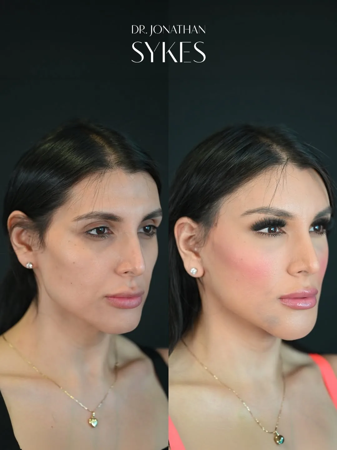 Before and after deep plane facelift — 32-year-old woman, oblique left view, 6mo post-op by Dr. Jonathan Sykes