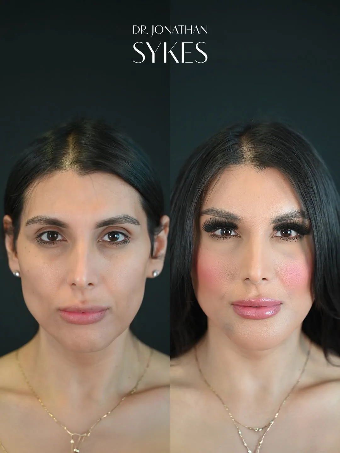 Before and after deep plane facelift — 32-year-old woman, frontal view, 7mo post-op by Dr. Jonathan Sykes