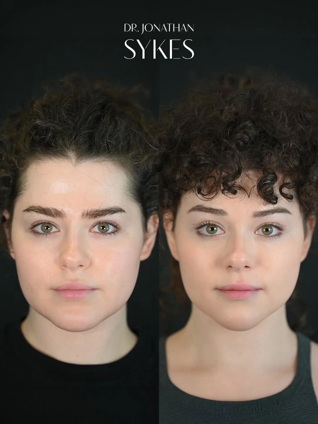 Before and after deep plane facelift — 28-year-old woman, frontal view, 6mo post-op by Dr. Jonathan Sykes